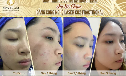 Những lưu ý khi sử dụng tỏi tươi trị mụn