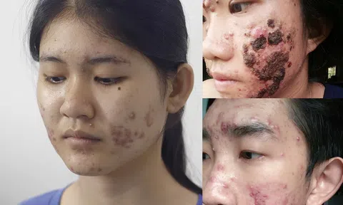 Những 'thủ phạm' gây ra mụn và cách chữa trị dứt điểm