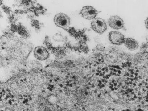 Chủng virus HIV mới phát hiện: Bác sĩ Việt Nam nói gì?