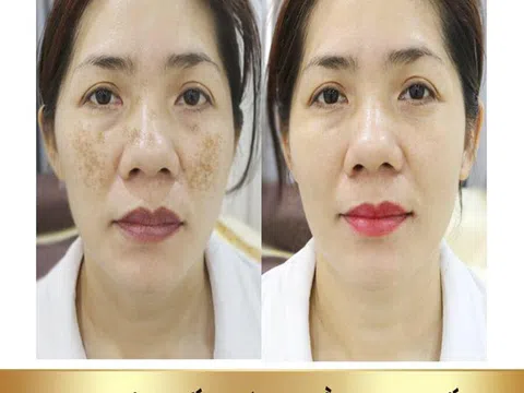 Thẩm mỹ viện quốc tế Bắc Âu điều trị sạch nám sáng da 1 lần