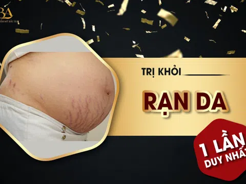 Điều trị rạn da tại Thẩm mỹ viện quốc tế Bắc Âu uy tín tại Hà Nội