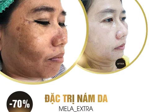 Thẩm mỹ viện Rose điều trị nám uy tín hiệu quả tại Hà Nội