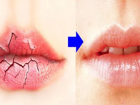 8 cách đánh bay đôi môi nứt nẻ mùa đông cực kì hiệu quả
