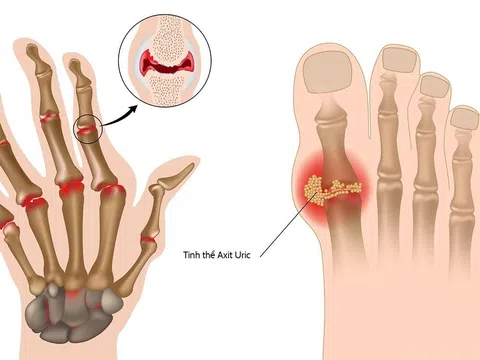 Chuyên gia giải mã tác dụng của nước điện giải ion kiềm trong phòng trừ gout