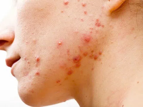 Cùng đi tìm nơi chữa viêm nang lông hiệu quả nhất...