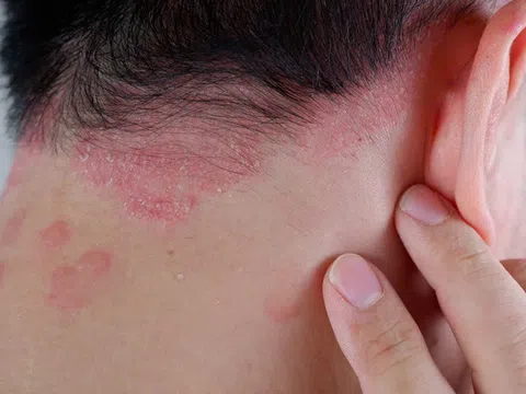 Vảy nến tái phát - Cách điều trị từ lời khuyên các chuyên gia Bảo Thanh Đường