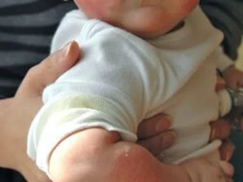 Cách nhận biết và kiểm soát dị ứng đạm sữa bò