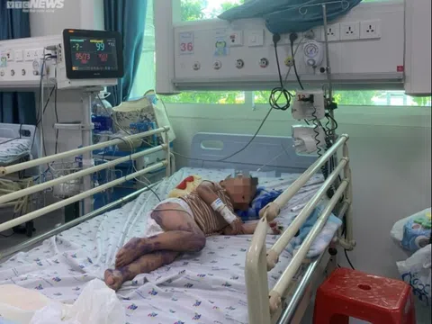 Virus gây bệnh tay chân miệng nặng ở trẻ em tái xuất tại TP.HCM