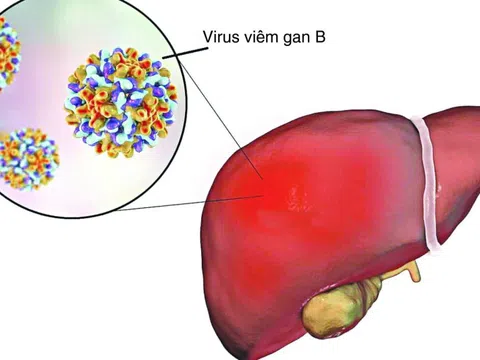 Viêm gan B sau bao lâu dẫn đến ung thư gan?