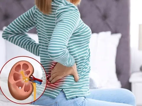 Những vị trí cơ thể có thể hình thành Sỏi