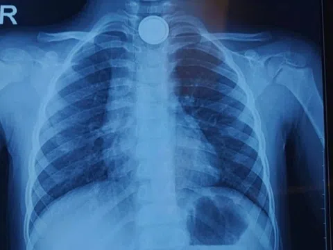 Bé 4 tuổi ở Hà Nội suýt thủng thực quản vì thứ hay thấy trong đồ chơi