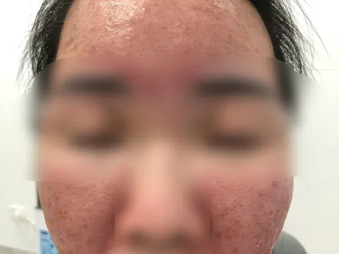Nữ sinh Hà Nội "cháy da" vì tin lời quảng cáo kem chống nắng giá rẻ trên mạng