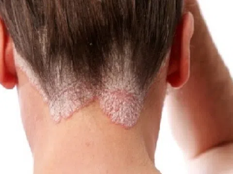 Điều trị sớm bệnh vẩy nến tránh nguy cơ biến chứng
