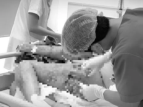 Nguy kịch sau khi tự trích mụn nhọt tại nhà