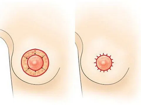 Thu nhỏ quầng nhũ hoa, phương pháp thẩm mỹ mang đến nét đẹp toàn diện
