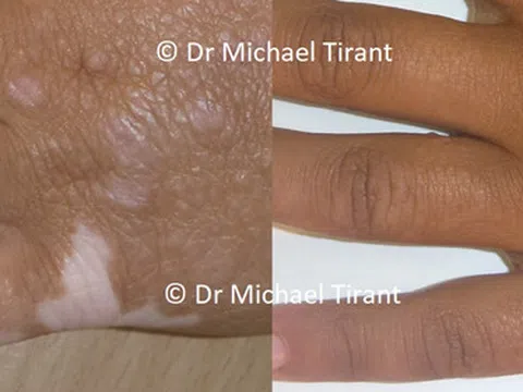 Điều trị bệnh bạch biến hiệu quả bằng thảo dược Vitilinex