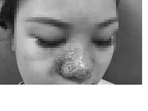 Hôm trước tiêm filler, hôm sau cầu cứu bác sĩ vì mũi đỏ như cà chua, chi chít mụn