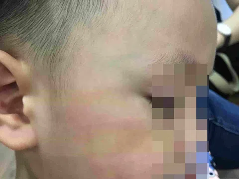 Trường mầm non Ecokids: 'Mẹ hiền' đánh con chảy máu miệng