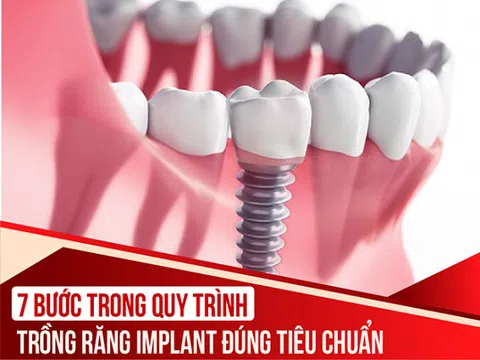 Quy trình 7 bước phẫu thuật cắm ghép Implant theo tiêu chuẩn vô trùng