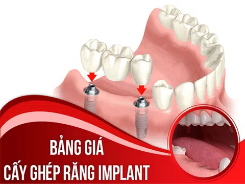 Bảng giá cấy ghép răng Implant tại Nha Khoa Đông Nam