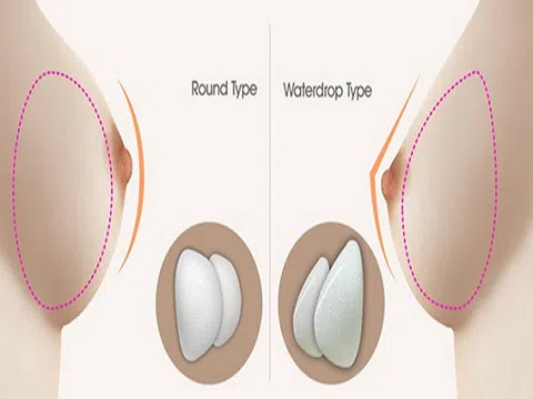 Nên nâng ngực túi giọt nước hay nâng ngực túi tròn?