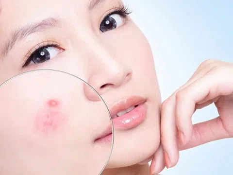 Nguyên nhân gây mụn trứng cá