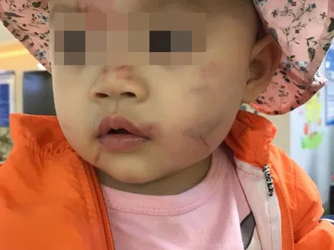 Công an điều tra làm rõ vụ trẻ mầm non bầm tím mặt sau ngày đầu đi học