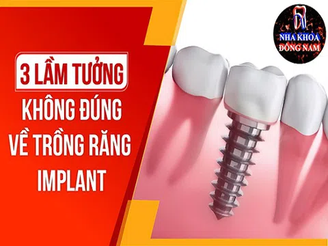 Những suy nghĩ sai lầm về cấy ghép răng Implant