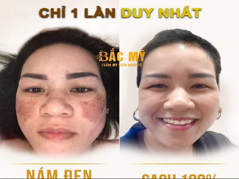 Tạm biệt thâm nám, tàn nhang với công nghệ Laser PicoSure tại TMV Quốc Tế Bắc Mỹ