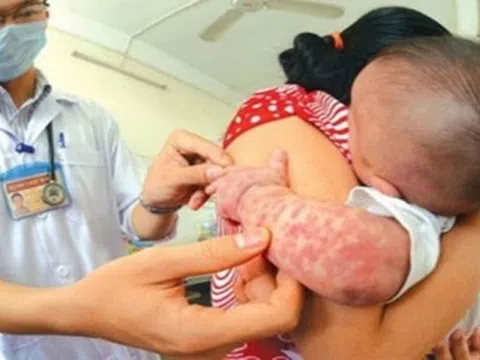 Đã có hơn 500 mắc, 3 ca tử vong do sởi, TPHCM đủ điều kiện công bố dịch?