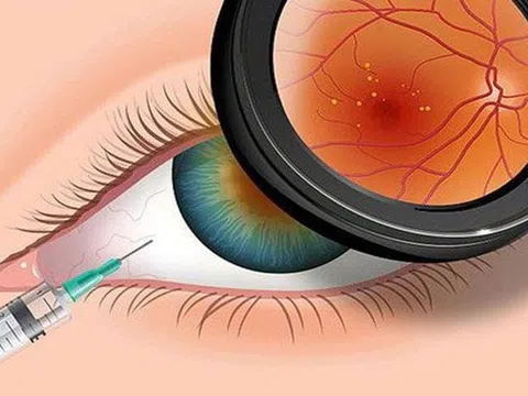 Bao lâu nên khám mắt 1 lần để phát hiện sớm thoái hóa điểm vàng?