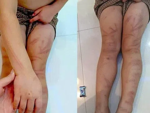 Vụ nhiều trẻ mầm non 5 tuổi bị đánh bầm tím: Tạm dừng công tác với giáo viên quản lý lớp