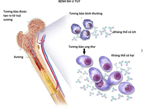 5 câu hỏi thường gặp với bệnh đa u tủy xương