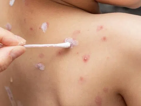 Phát hiện ổ bệnh thủy đậu tại một trường học ở Bến Tre