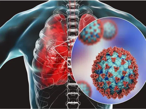 Nhiều trẻ viêm phổi do vi khuẩn tụ cầu, cách phát hiện sớm căn bệnh này