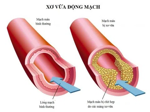 Cách giúp phòng xơ vữa động mạch, ngăn ngừa đột quỵ
