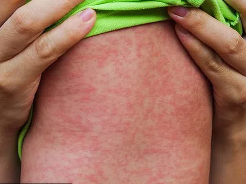 Số ca mắc sởi tăng 2,7 lần, cần đưa trẻ đến cơ sở y tế khi nào?