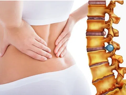 Những lưu ý không thể bỏ qua cho người bị thoát vị đĩa đệm