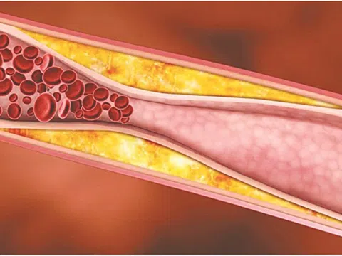 Mỡ máu bao nhiêu là cao, nên ăn uống gì?