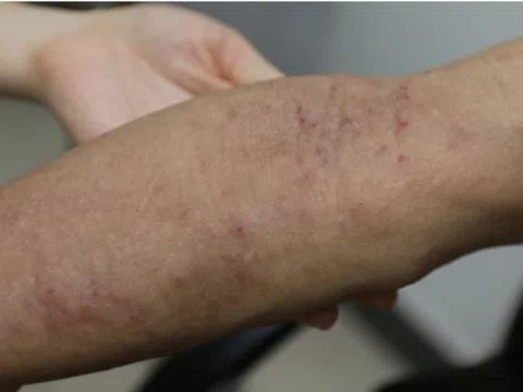 Viêm da cơ địa dễ tái phát khi giao mùa