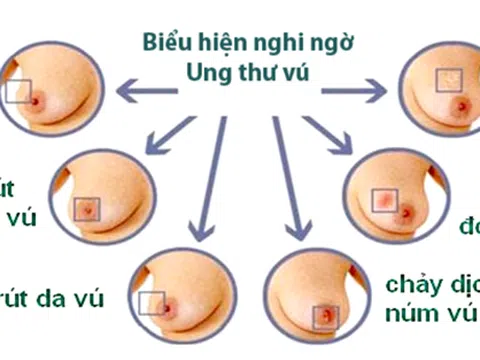 Tại sao tuổi cao trở thành yếu tố nguy cơ của ung thư?