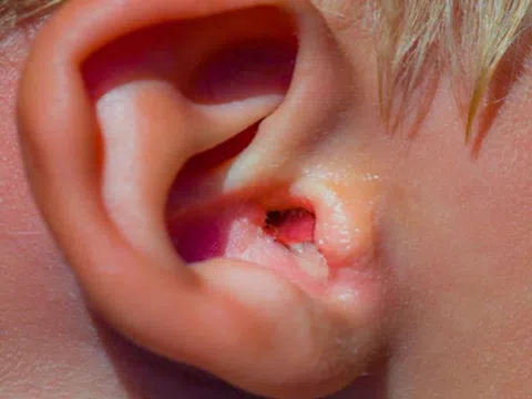 Biểu hiện viêm tai ngoài và cách phòng tránh