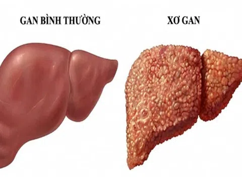 Xơ gan gây xuất huyết tiêu hóa có triệu chứng gì?