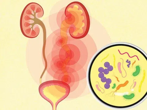Viêm đường tiết niệu: nguyên nhân và hậu quả đáng sợ