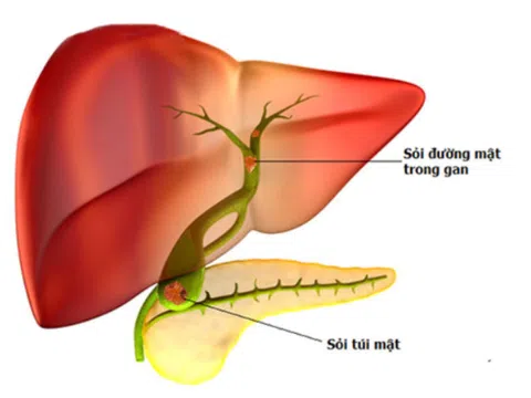 Biến chứng nguy hiểm của sỏi đường mật trong gan
