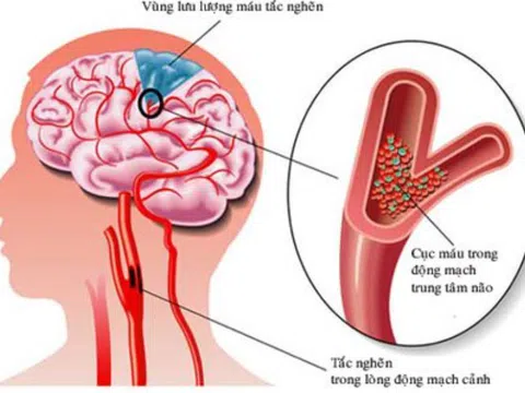 Những thói quen xấu khiến bạn dễ bị đột quỵ