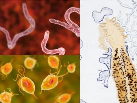 Cảnh giác với sán lá phổi