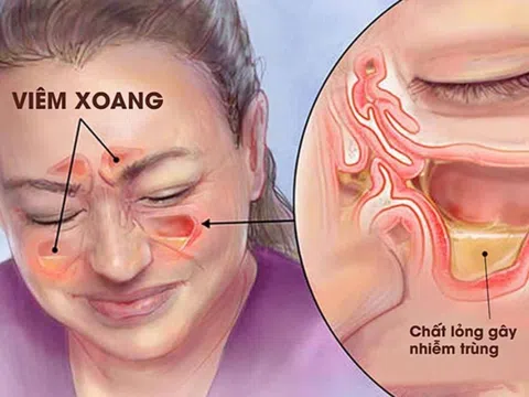 Viêm xoang cấp có nguy hiểm không?