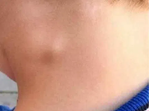 Lao hạch có lây không, triệu chứng thế nào?