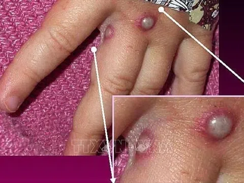 Phát hiện ca mắc bệnh đậu mùa khỉ đầu tiên bên ngoài châu Phi